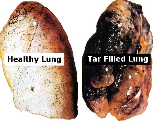 pic of lungs from smoking