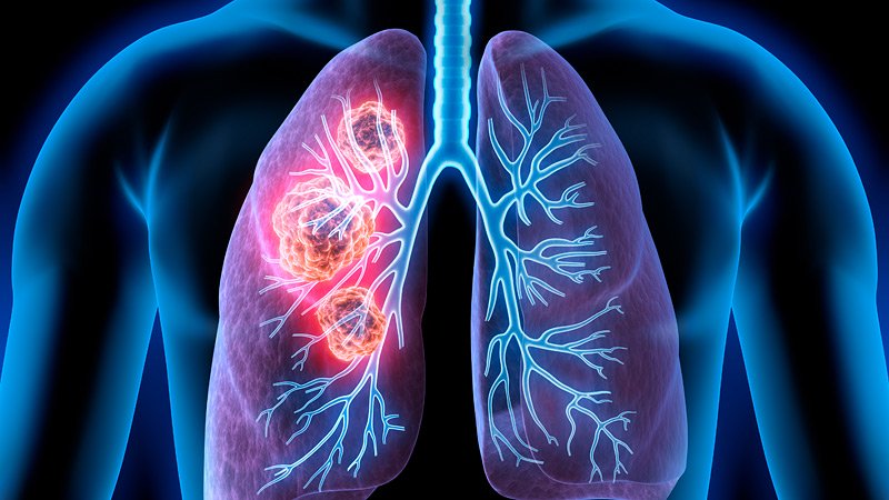 lung cancer pic
