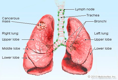 lung cancer pictures real