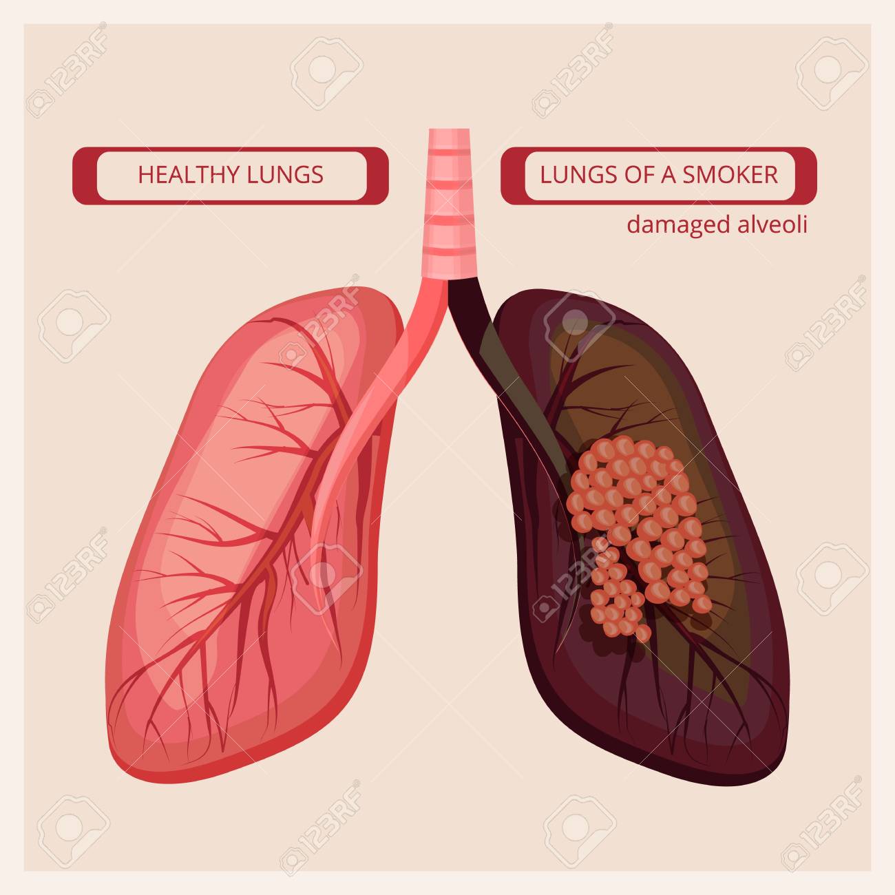 images of damaged lungs due to smoking