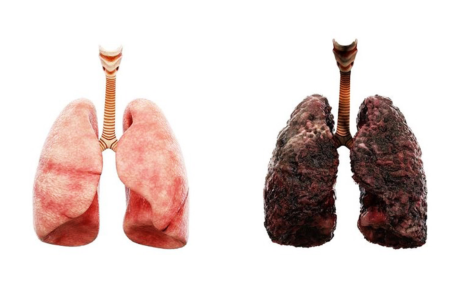 lung cancer pictures from smoking
