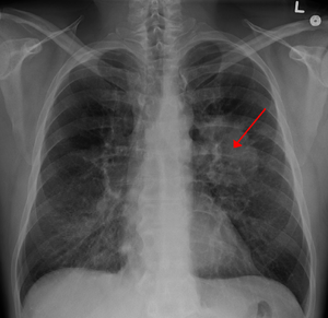 lung cancer pictures images