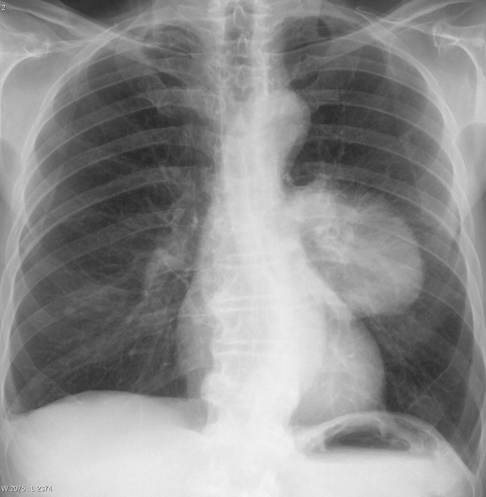 lung cancer chest x ray pictures