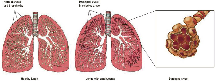 pics of lungs with emphysema