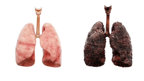 pictures of lungs with emphysema