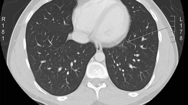 lung cancer pictures ct scan