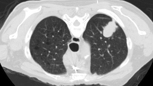 lung cancer pictures ct scan