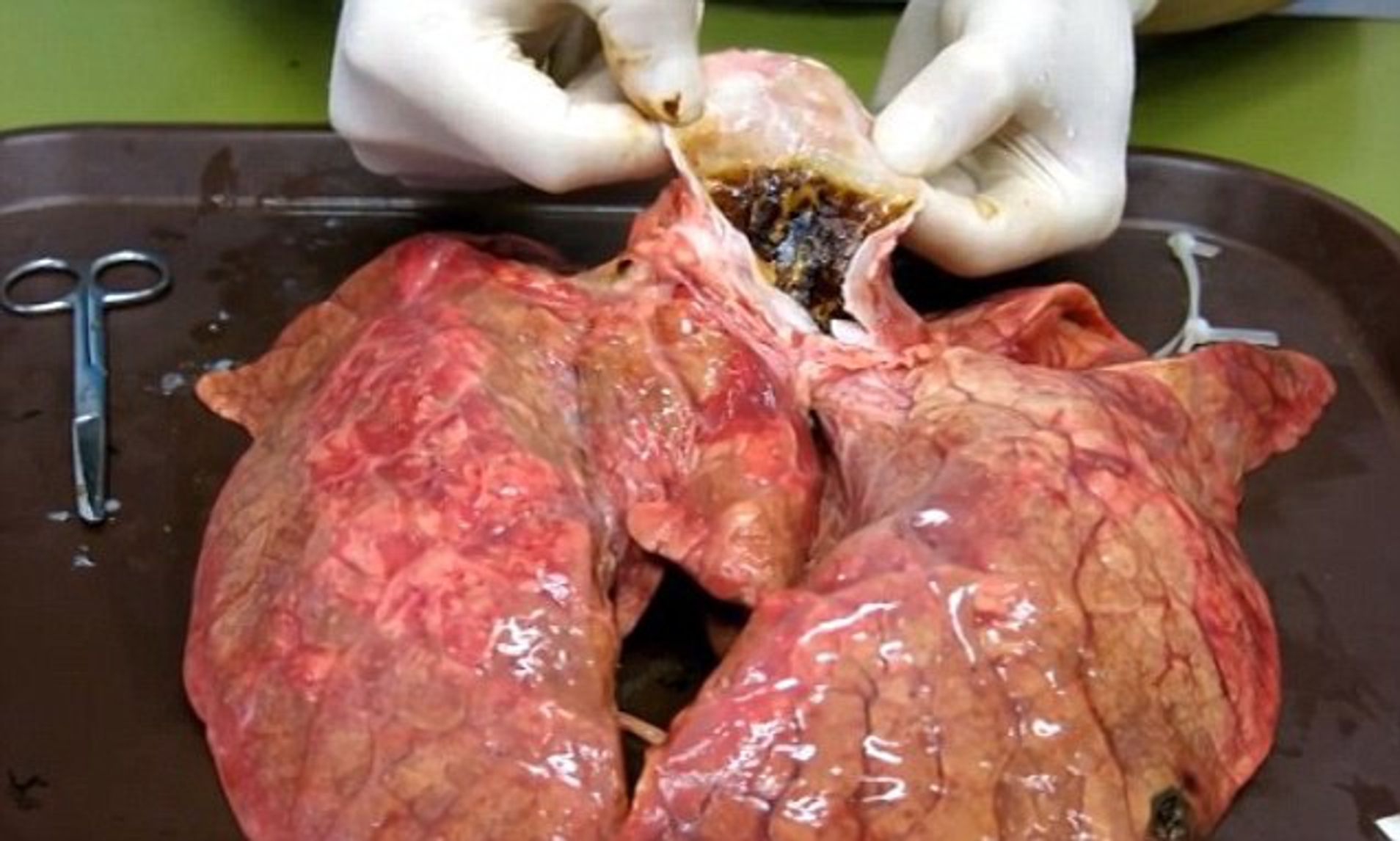 pictures of lungs after smoking for 5 years