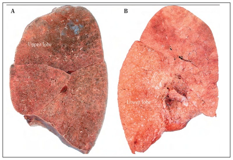 photos of lungs with emphysema