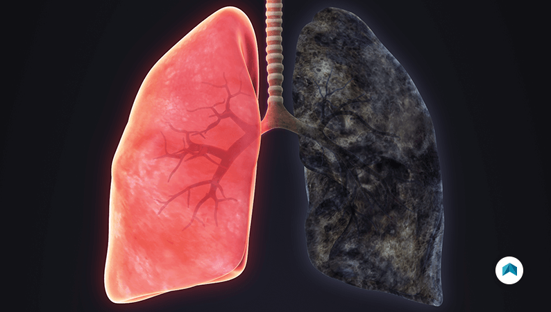 photos of lungs with emphysema
