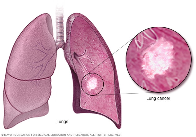 lung cancer pictures of patients