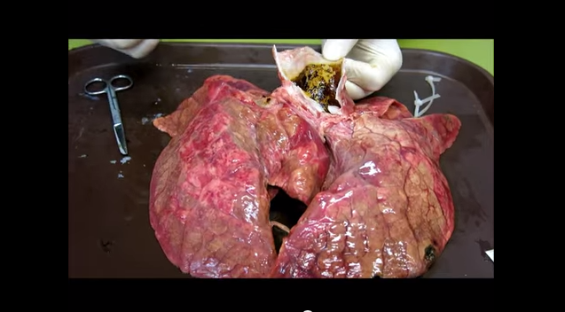 pictures of damaged lungs caused by smoking