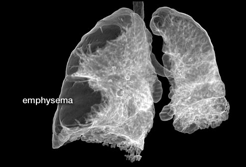 images of lungs with emphysema
